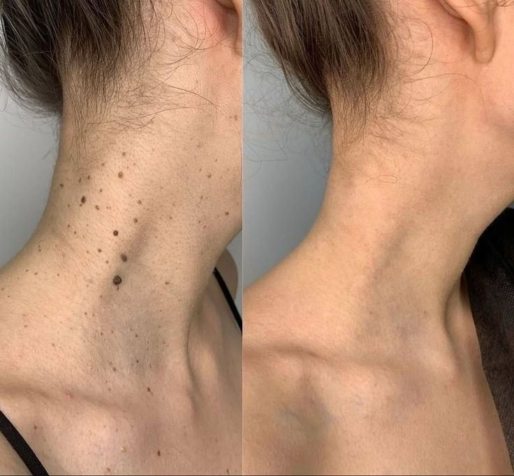 Resultado antes e depois — Paula H.