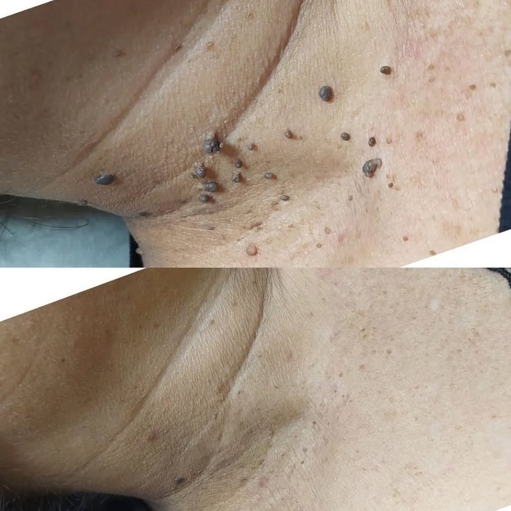 Resultado antes e depois — Simone V.
