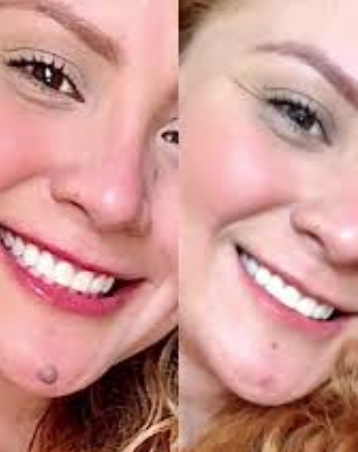 Antes e Depois Amanda