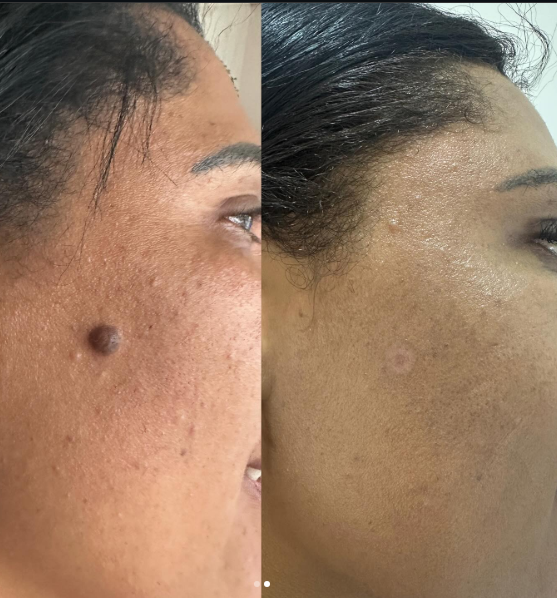 Antes e Depois Thaís